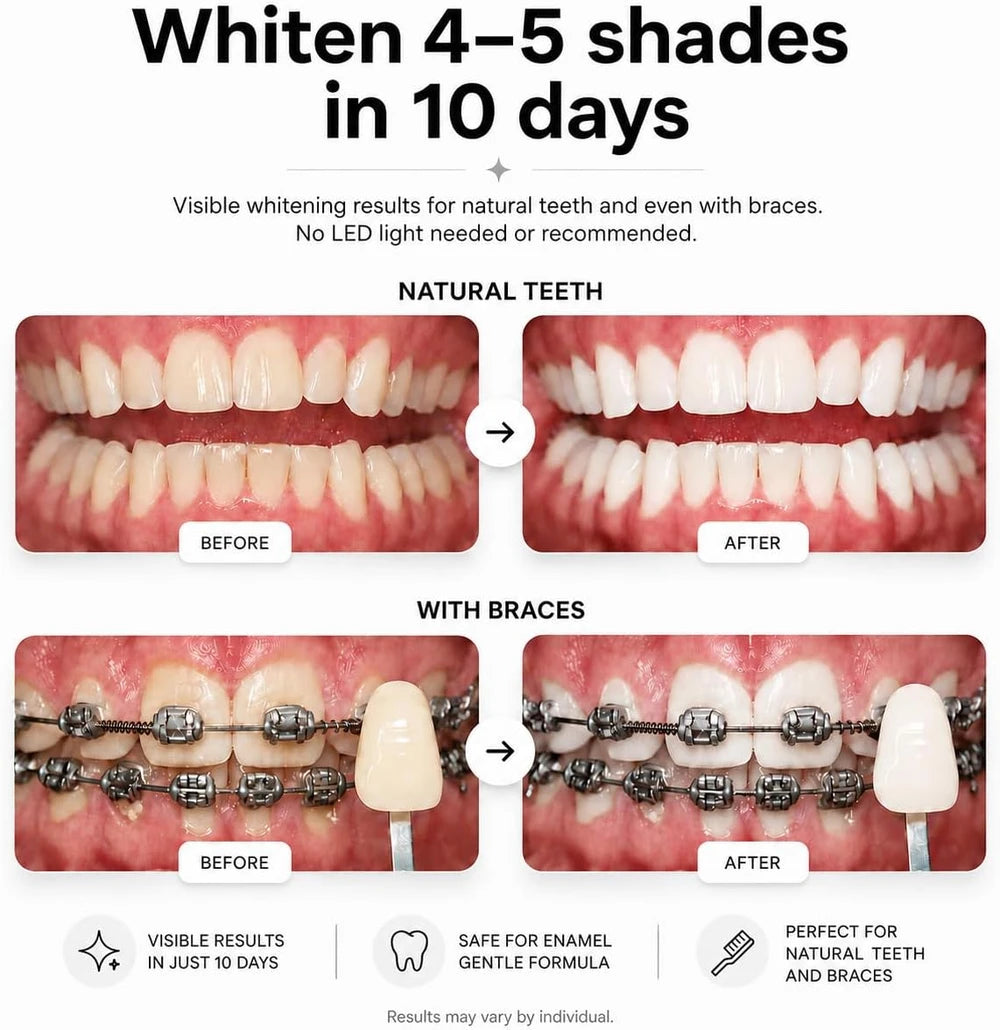 Opalescence Go Teeth Whitening Trays